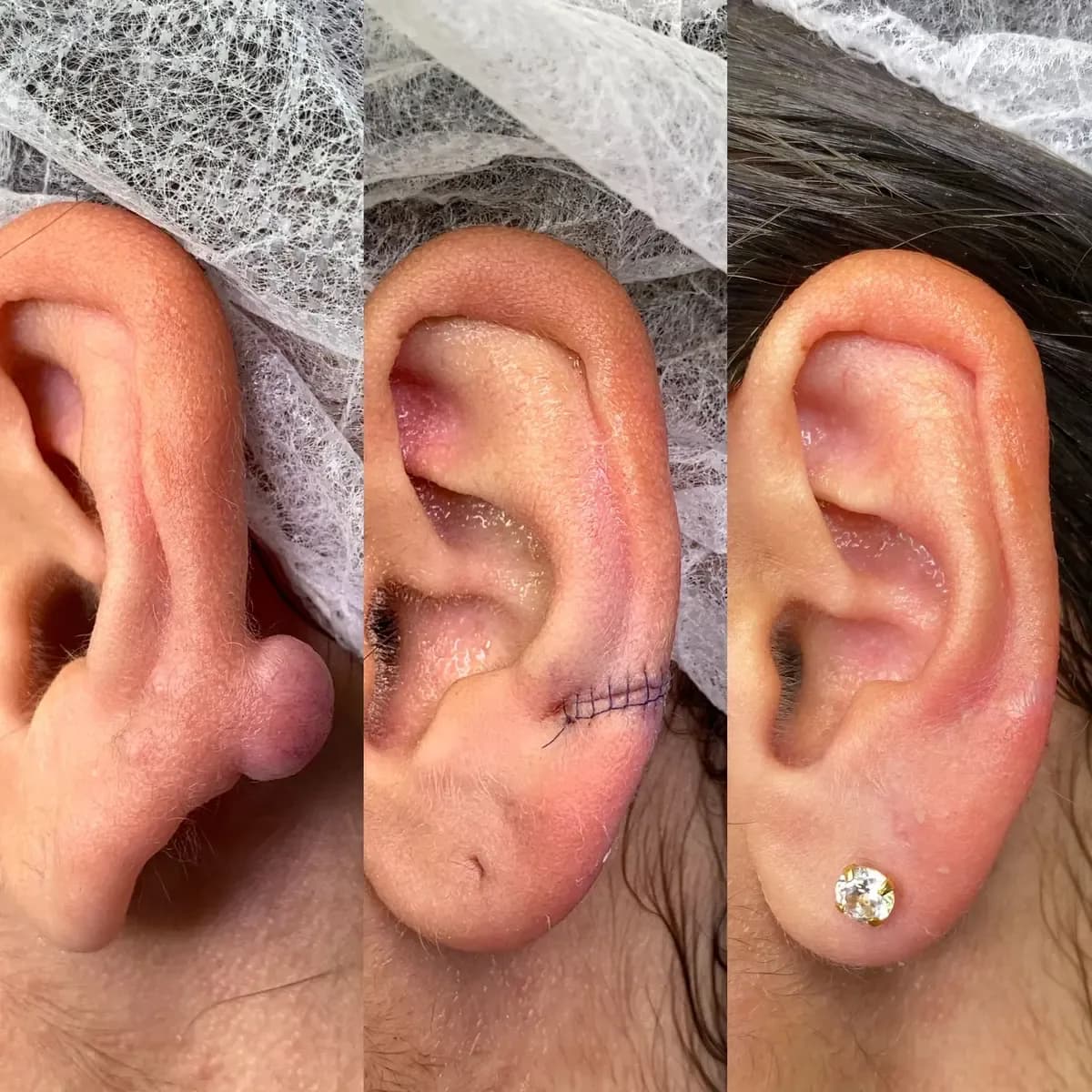 Ohr mit Knubbel vor und nach der Entfernung, mit Naht und Ohrstecker – Arbeit von Oskar, Riverside Ink St. Margrethen