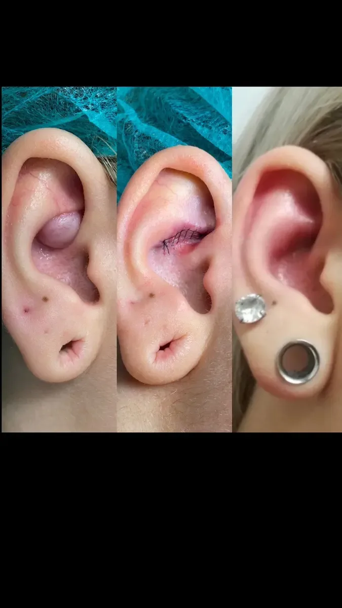 Ohr mit Knubbel, Naht und Ergebnis mit Ohrstecker und Flesh-Tunnel – Arbeit von Oskar, Riverside Ink St. Margrethen